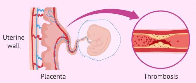 سن حاملگی در زمان SAB می تواند سرنخ هایی درباره علت ایجاد کند.